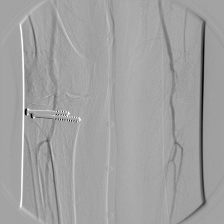 Radiant-Dicom-Viewer-DSA-Lower-Limbs-Corrected-Left