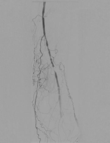 Radiant-Dicom-Viewer-DSA-Mask-Misaligned-Corrected