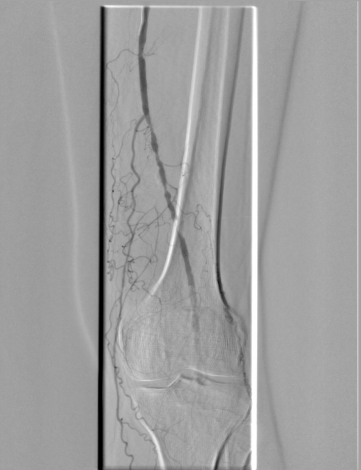 Radiant-Dicom-Viewer-DSA-Mask-Misaligned