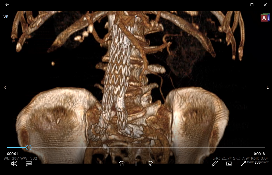 RadiAnt-DICOM-Viewer-VR-Movie