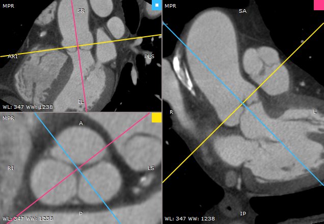 RadiAnt_DICOM_Viewer_3DMPR_Sample_Aorta