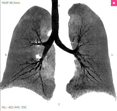 RadiAnt_DICOM_Viewer_3DMPR_ThicknessMinIP