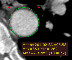 RadiAnt_DICOM_Viewer_Adjust_Measurements_Ellipse_Circle