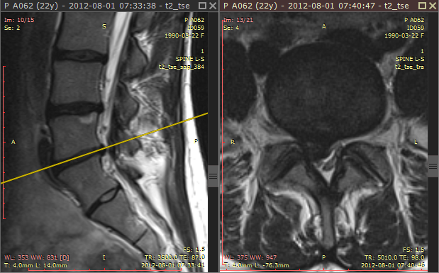 RadiAnt_DICOM_Viewer_Annotations_Cross_Reference_Lines_1