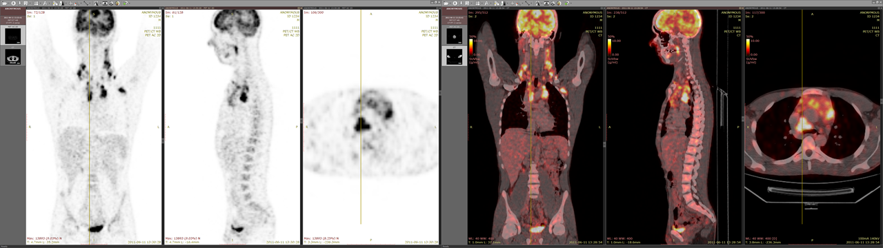 PET-CT fusion displayed on two monitors