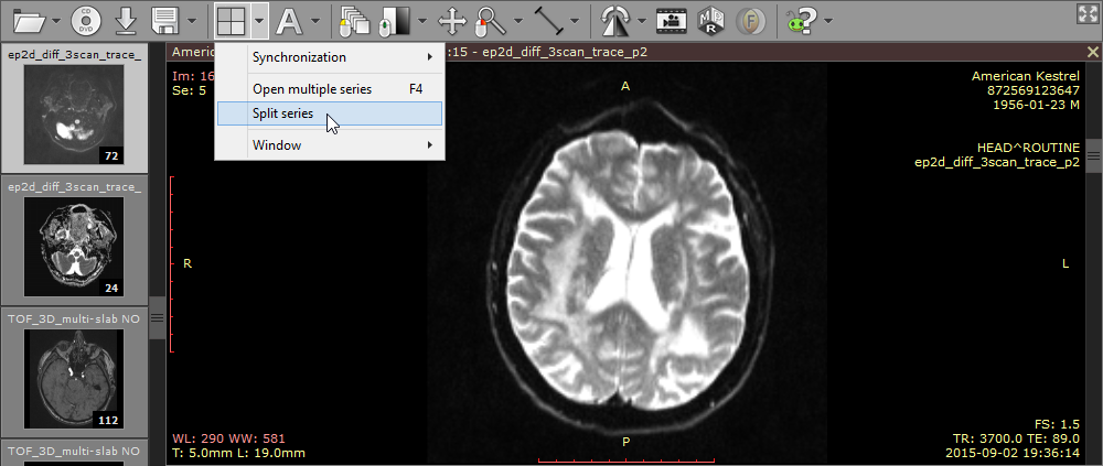 Image series containing three DWI sequences with different b-values.