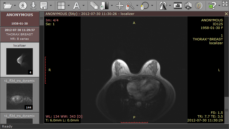 RadiAnt_DICOM_Viewer_Time_Intensity_Curves_MR_Breast_Study