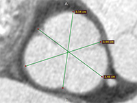 Blog image - 3D MPR in action