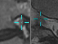 Blog image - 3D Cursor in RadiAnt DICOM Viewer 4.5.9 BETA