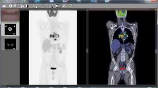 RadiAnt DICOM Viewer PET-CT fusion preview