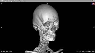 3D printing with RadiAnt DICOM Viewer - STL export