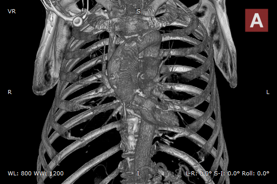 RadiAnt-DICOM-Viewer-3D-Volume-Rendering-Presets-Bones-BW