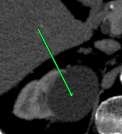 Radiant-Dicom-Viewer-Arrow-Sample