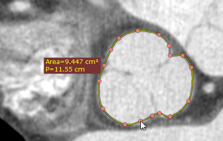 Radiant-Dicom-Viewer-Closed-Polygon-Add-Node