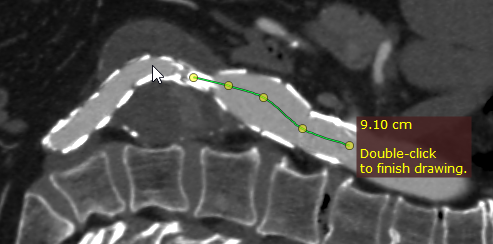 Radiant-Dicom-Viewer-Open-Polygon-Draw