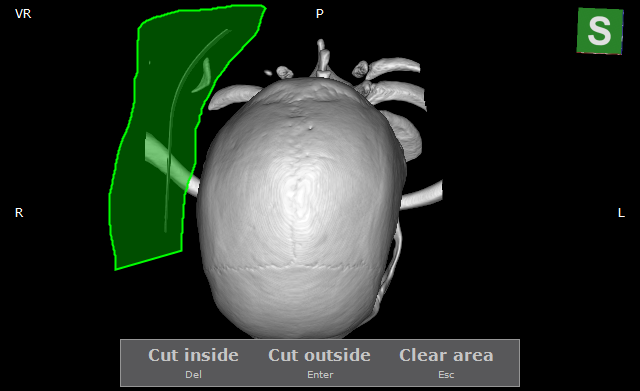 RadiAnt-DICOM-Viewer-STL-Export-Cut-Objects