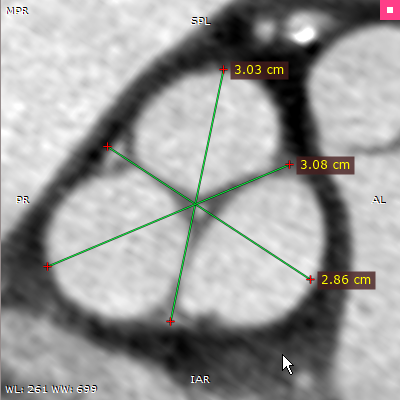 RadiAnt_DICOM_Viewer_3DMPR_LengthMeasurement