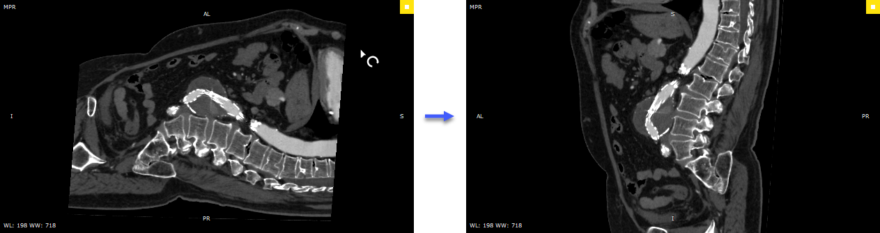 RadiAnt_DICOM_Viewer_3DMPR_Roll