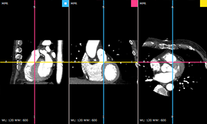 RadiAnt_DICOM_Viewer_3DMPR_ViewportLayoutCols3