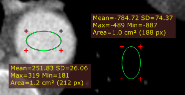 RadiAnt_DICOM_Viewer_Adjust_Measurements_Ellipse