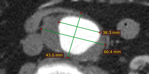 Measured distance is calibrated (the pixel spacing element is present).