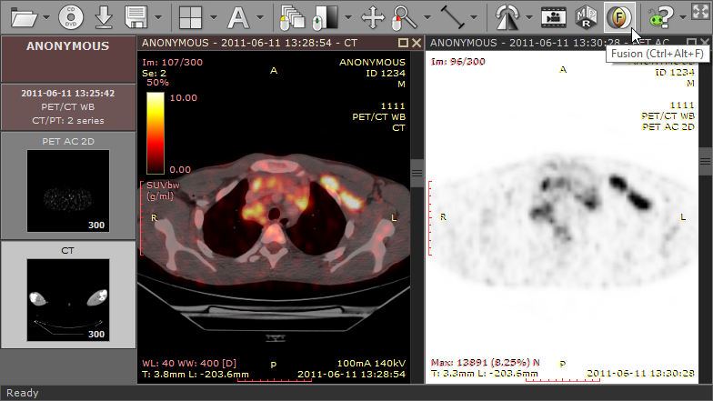 RadiAnt_DICOM_Viewer_Image_Fusion_CT_PET_Screen