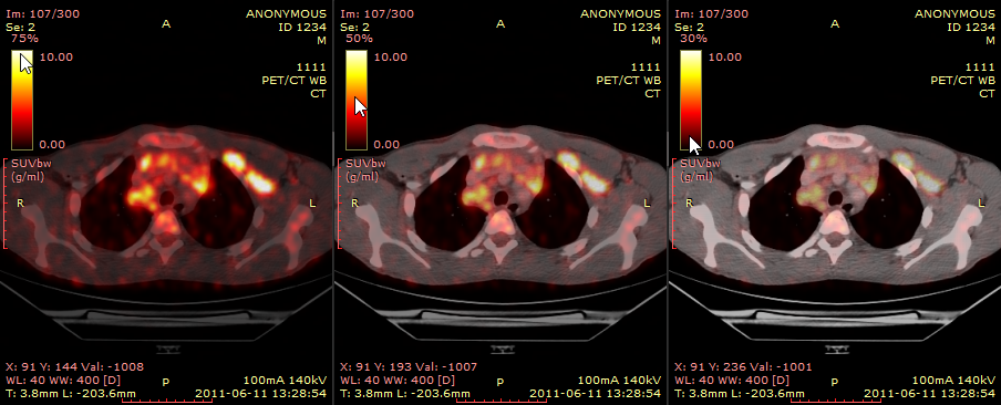 RadiAnt_DICOM_Viewer_Image_Fusion_PET_CT_Adjusting_Opacity