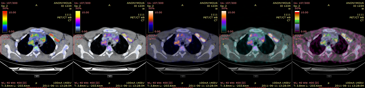 RadiAnt_DICOM_Viewer_Image_Fusion_PET_CT_Color_Scales