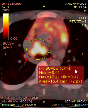 RadiAnt_DICOM_Viewer_Image_Fusion_PET_CT_SUVbw_Measurement