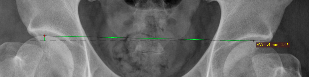 RadiAnt_DICOM_Viewer_Measurements_Deviation_Vertical