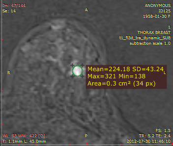 RadiAnt_DICOM_Viewer_Time_Intensity_Curves_Ellipse_ROI