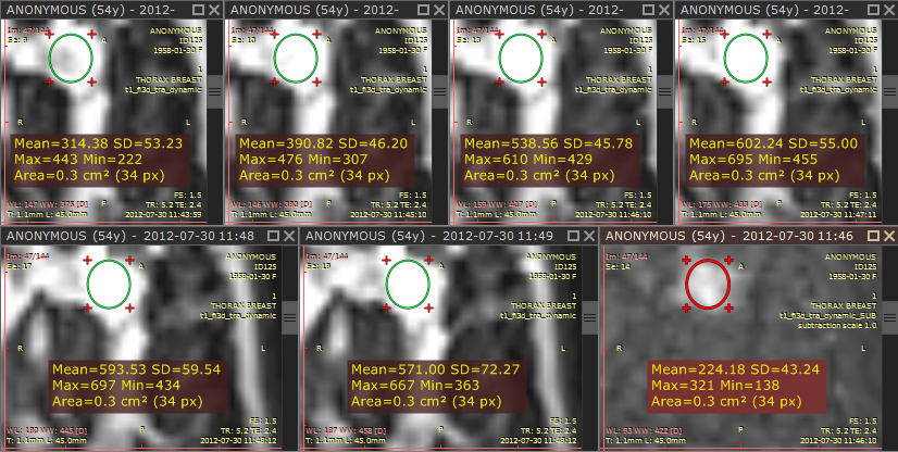 RadiAnt_DICOM_Viewer_Time_Intensity_Curves_Ellipse_ROI_Duplicated