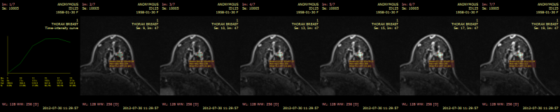 RadiAnt_DICOM_Viewer_Time_Intensity_Curves_Generated_Series