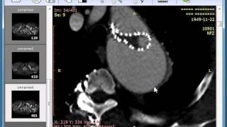 RadiAnt DICOM Viewer 0.19 in action