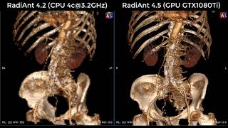 RadiAnt DICOM Viewer 4.5 preview - GPU Volume Rendering