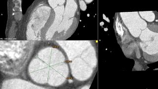 RadiAnt DICOM Viewer - 3D MPR - Aortic Valve