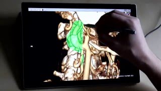 RadiAnt DICOM Viewer - Volume Rendering on Surface Pro 4